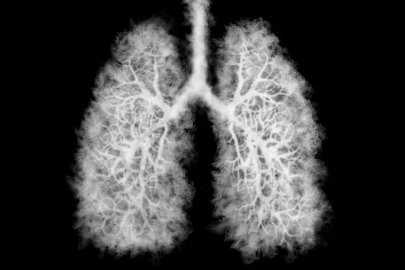 Imagem de um pulmão que possui a doença chamada Popcorn Lung